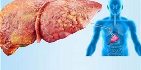علامات الكبد الدهني التي قد تظهر على الجسم