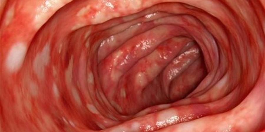 أعراض وأسباب إلتهاب القولون المجهري وأسباب الإصابة به